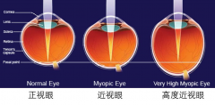 超过600度的近视戴眼镜有哪些好处?如何配高度数眼镜?